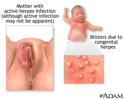 herpes infection